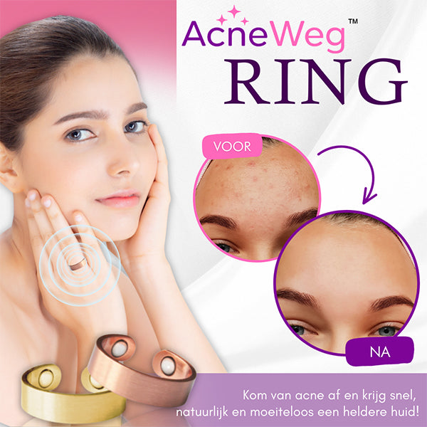 AcneWeg™ Ring