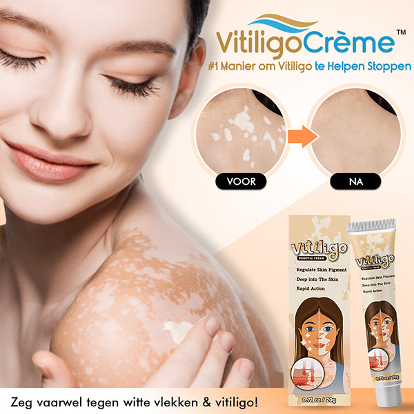 VitiligoCrème™ #1 Manier om Vitiligo te Helpen Stoppen